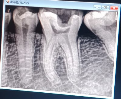 Single-Sitting Root Canal Treatment for International Travelers