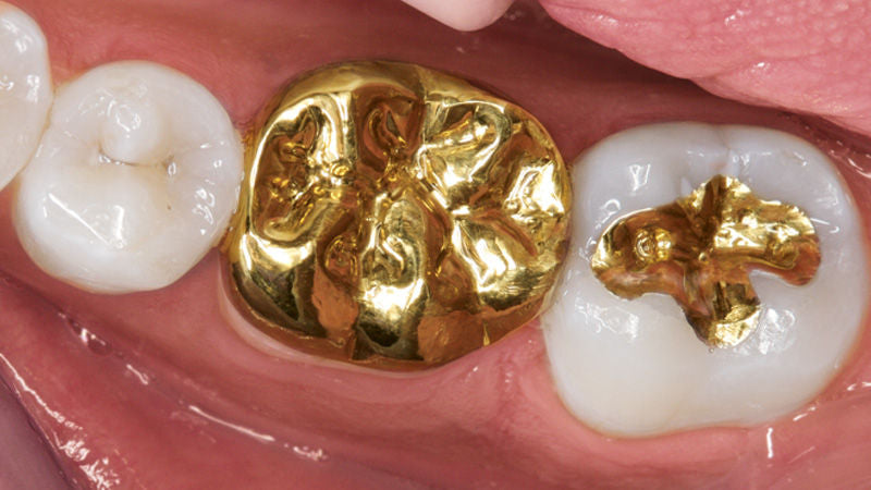 Gold Cast Crowns